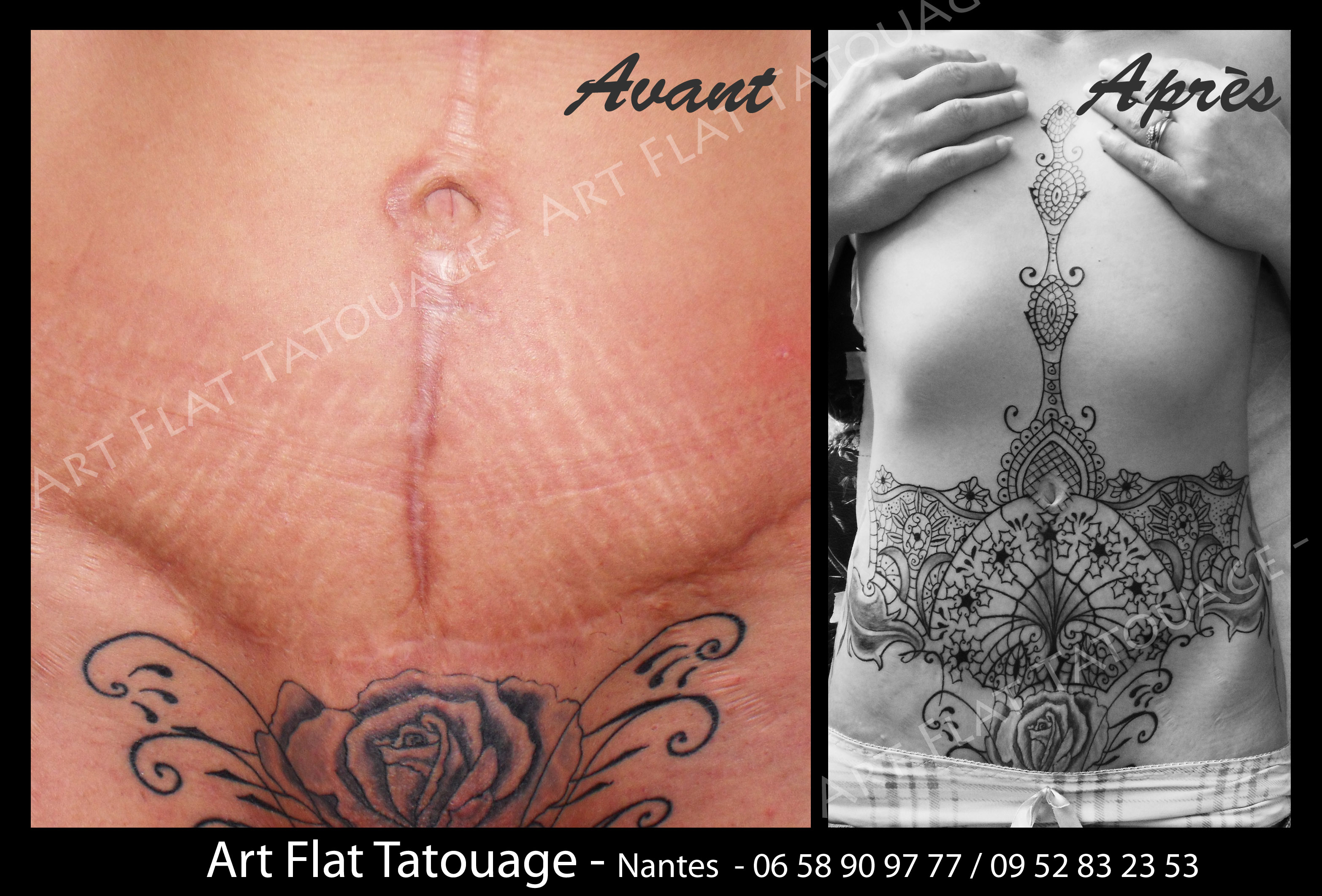 tatouage cicatrice ventre